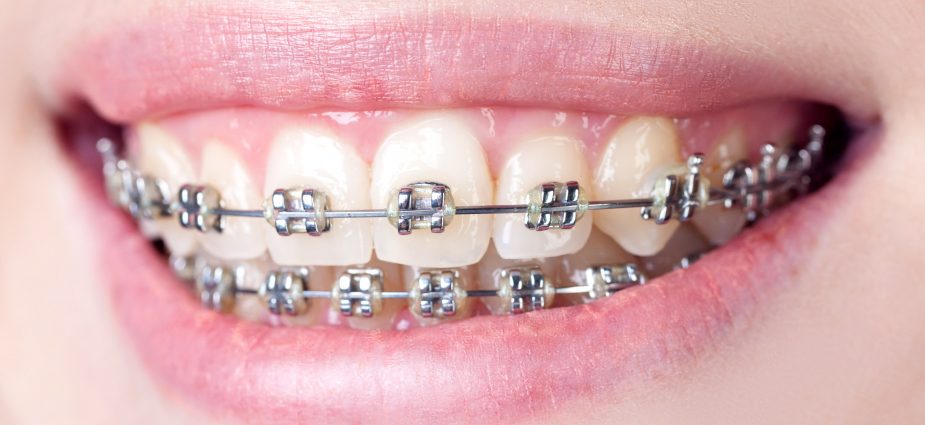 Braces-Orthodontics at Chellammal Dental Care
