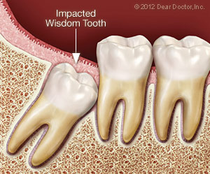 Extractions & Wisdom Teeth Removal at Chellammal Dental Care
