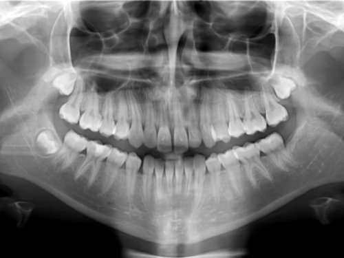 TMJ Treatment at Chellammal Dental Care