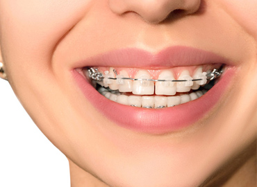 Braces and Orthodontics Treatment in Kallakurichi