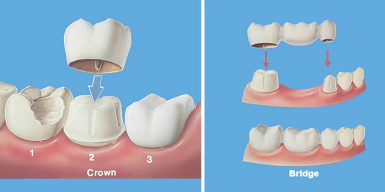 Crowns and Bridges Treatment in Kallakurichi
