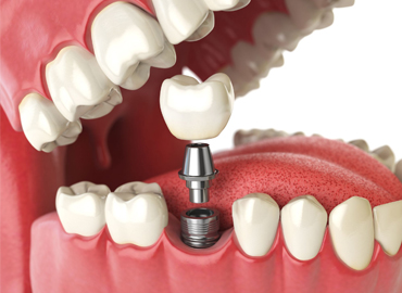 Dental Implants in Kallakurichi - Best Dental Clinic