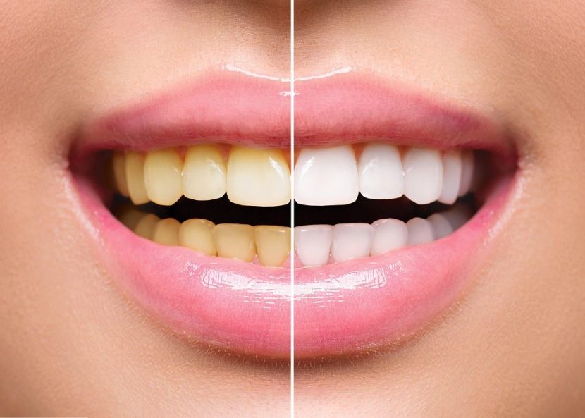 Tooth Whitening at Chellammal Dental Care